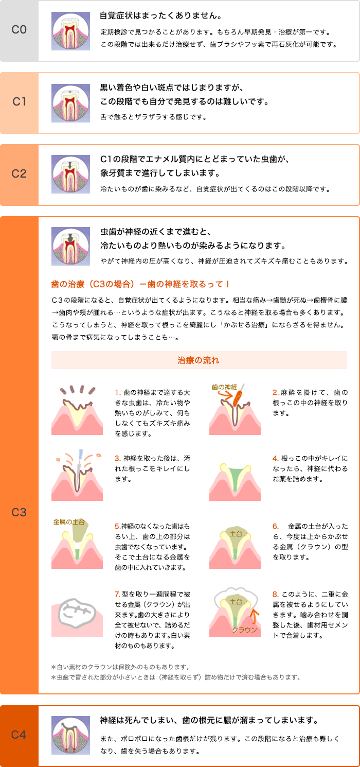 虫歯の段階（治療C3の場合）についてご説明します